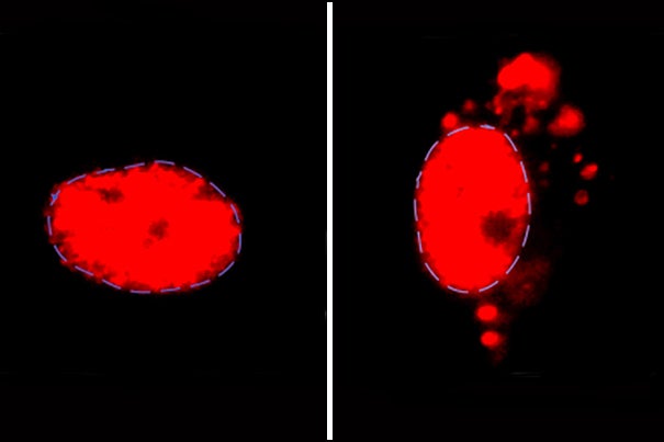 Normally, U2-snRNP (red) is found in the nucleus of motor neurons (left), but accumulates outside the nucleus in ALS or FTD patient-derived neurons with C9ORF72 mutation.
