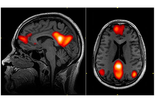 An MGH study has found that the use of fMRI and EEG may provide early detection of consciousness in patients with severe traumatic brain injury.