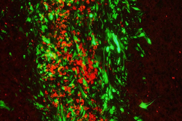 Metastatic tumor deposits in the brain are shown in green, while therapeutic stem cells are marked in red. Cancer-killing viruses that can deliver stem cells may provide a solution to tumor cells that have metastasized to the brain. 
