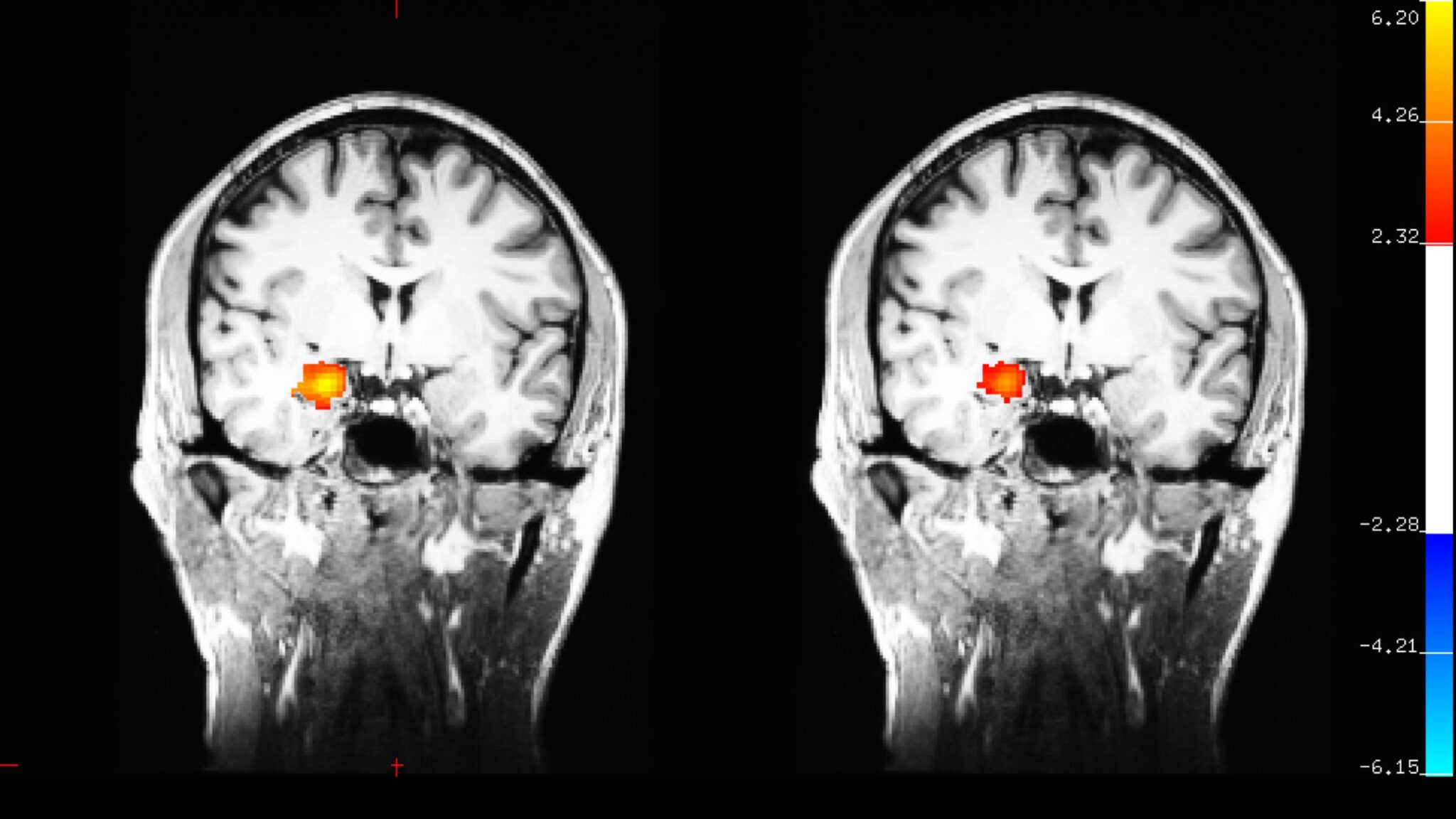 amygdala before and after meditation
