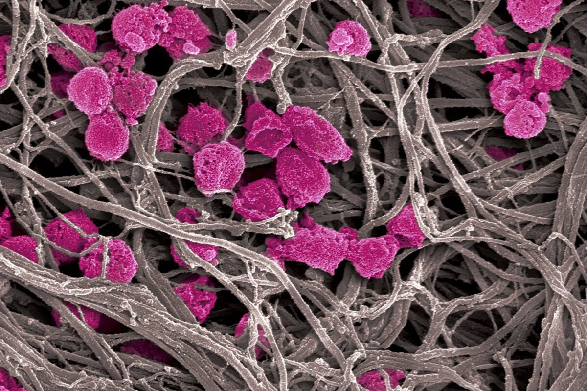 Platelet decoys (pink), unlike normal platelets, are not activated by collagen fibers (gray), making them an attractive option for antithrombotic and cancer treatment. 