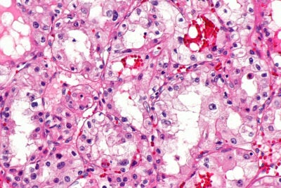 Micrograph of clear cell renal cell carcinoma.