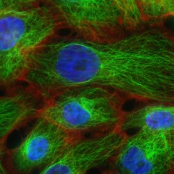 Human breast cancer cells. 