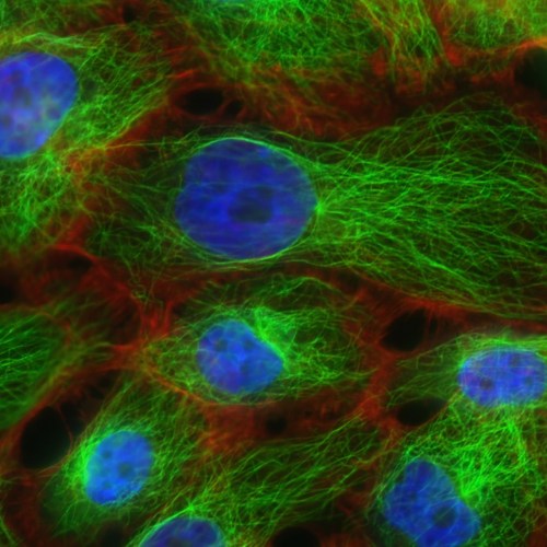 Human breast cancer cells. 