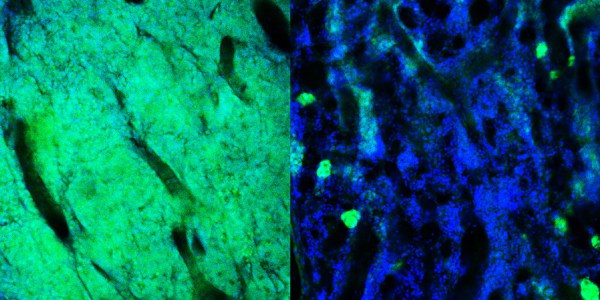 Bone marrow showing leukemia cells.