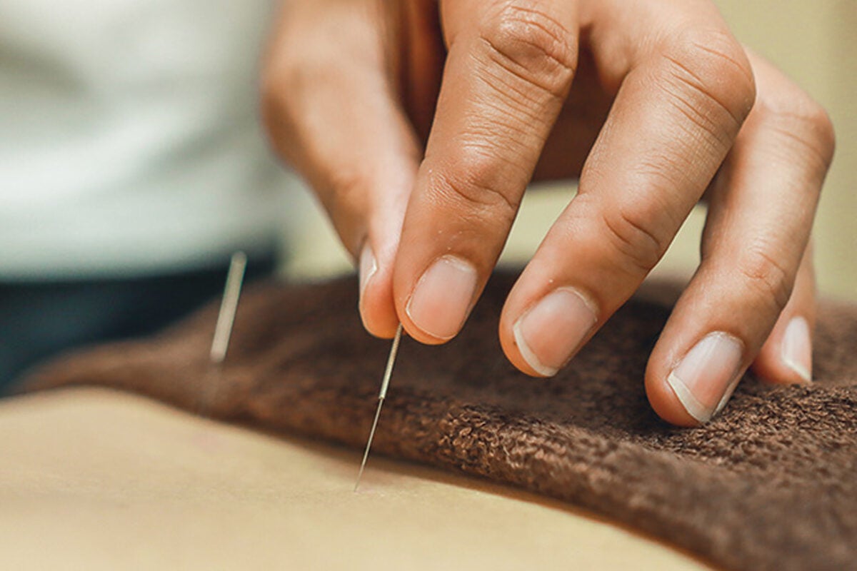 Person receiving acupuncture.