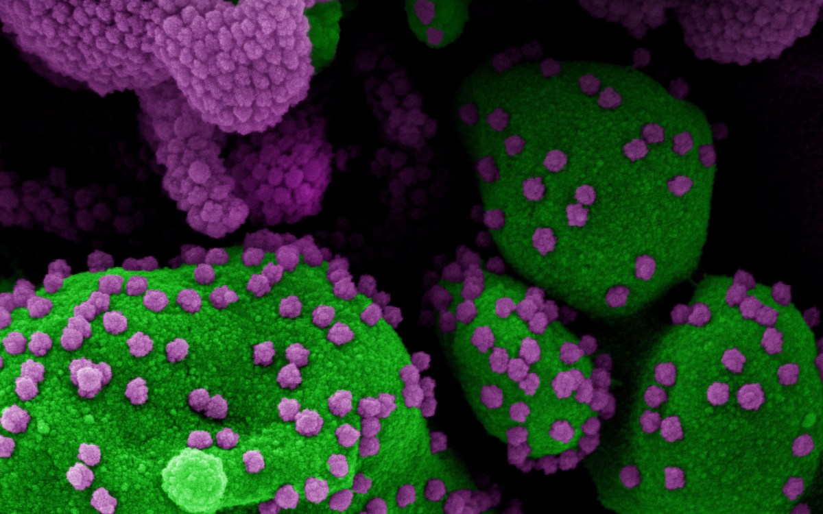 Micrograph showing heavily infect COVID patient.