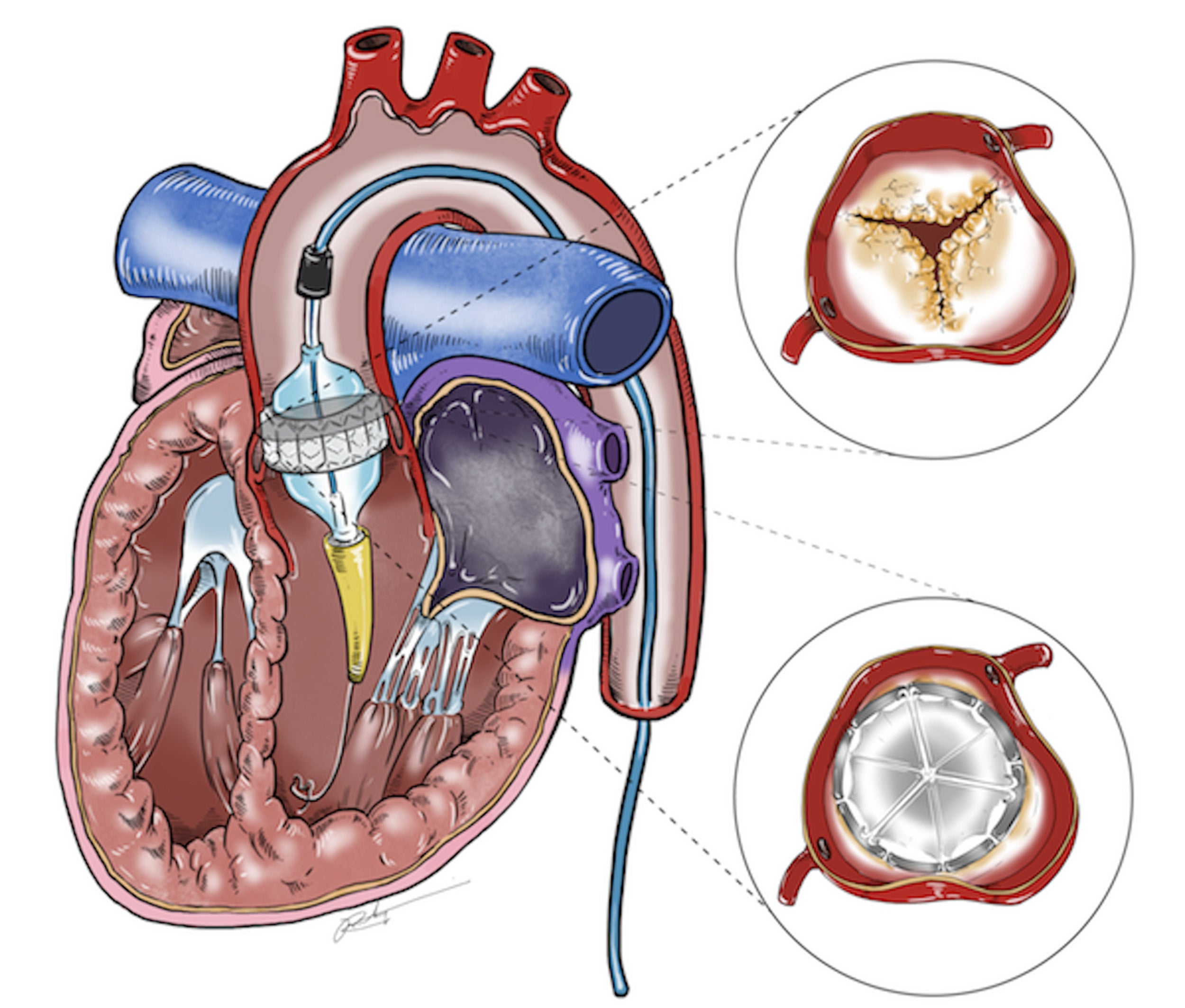 Drawing of aortic valve replacement.