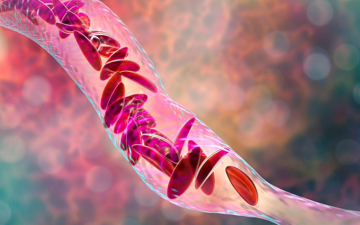 Sickle cell anemia, 3D illustration.