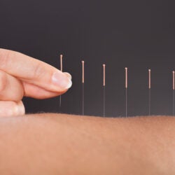 Researchers pinpoint how acupuncture targets inflammation
