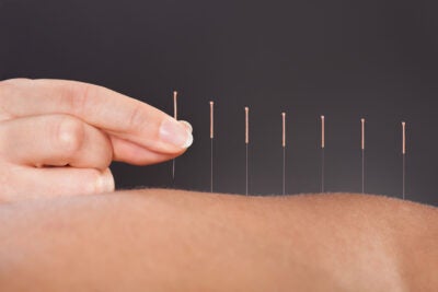 Acupuncture needles.