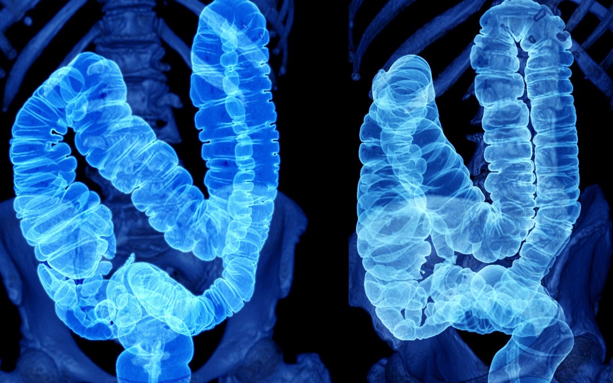 CT Scan of Colon 3D Rendering image.