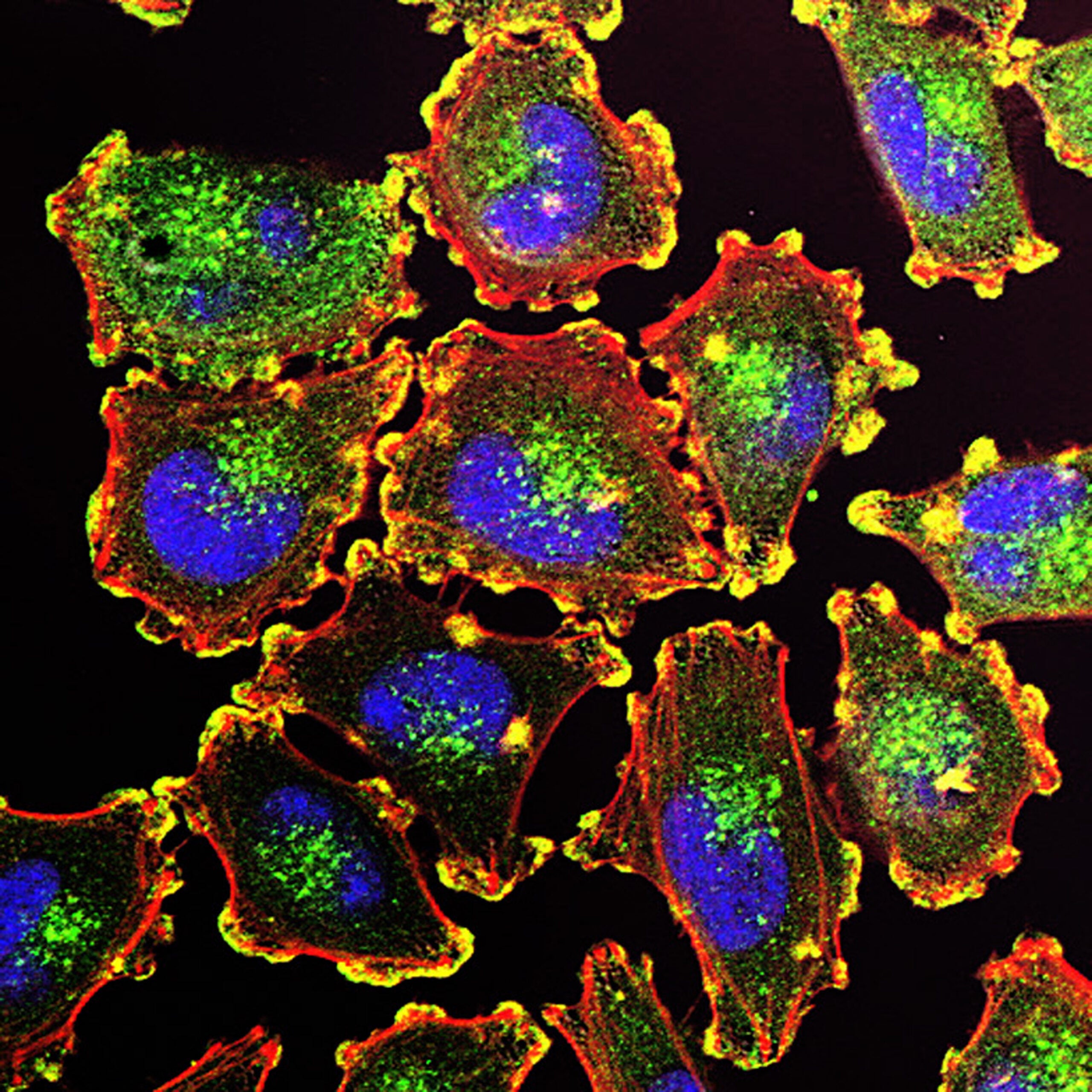 Melanoma cells.