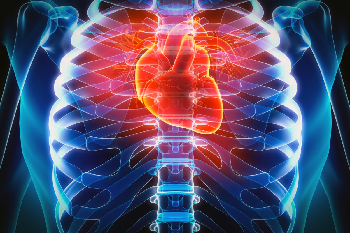 Broken heart syndrome: Key factor is stress, not love – Harvard ...