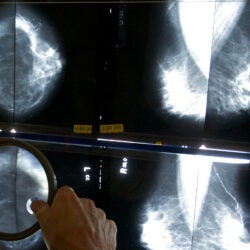 Radiologist examines mammograms with magnifying glass.