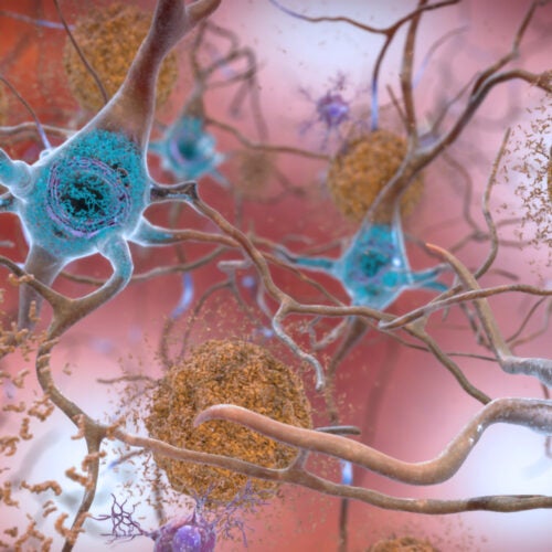 Beta-amyloid plaques and tau in the brain.