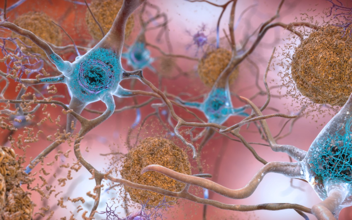 Beta-amyloid plaques and tau in the brain.