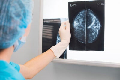 Breast scan image.