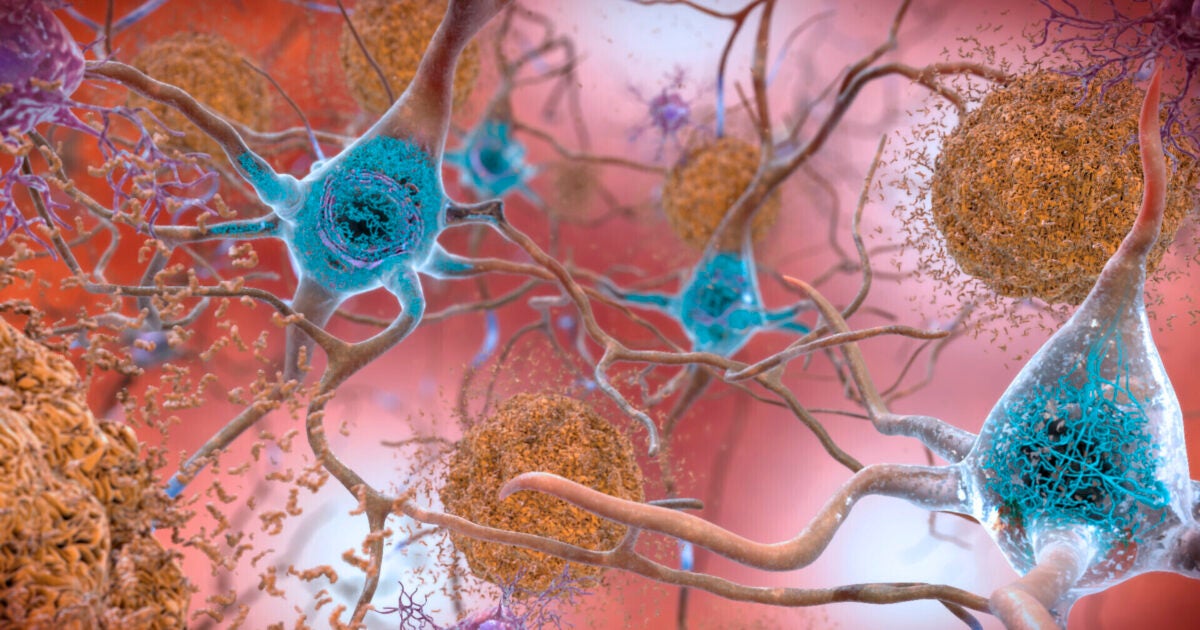 Start of new era for Alzheimer’s treatment