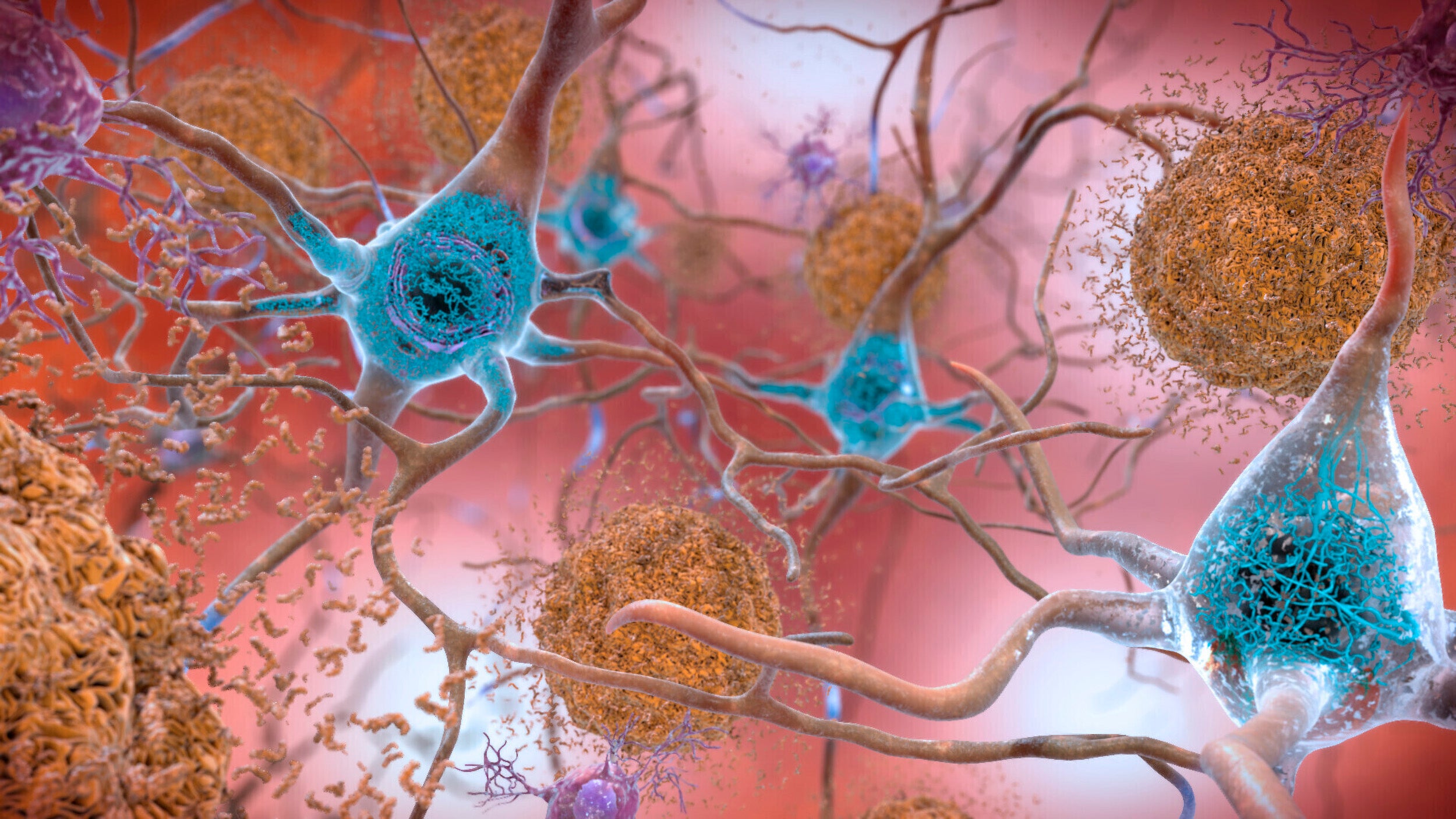 Illustration of cells in an Alzheimer’s affected brain.