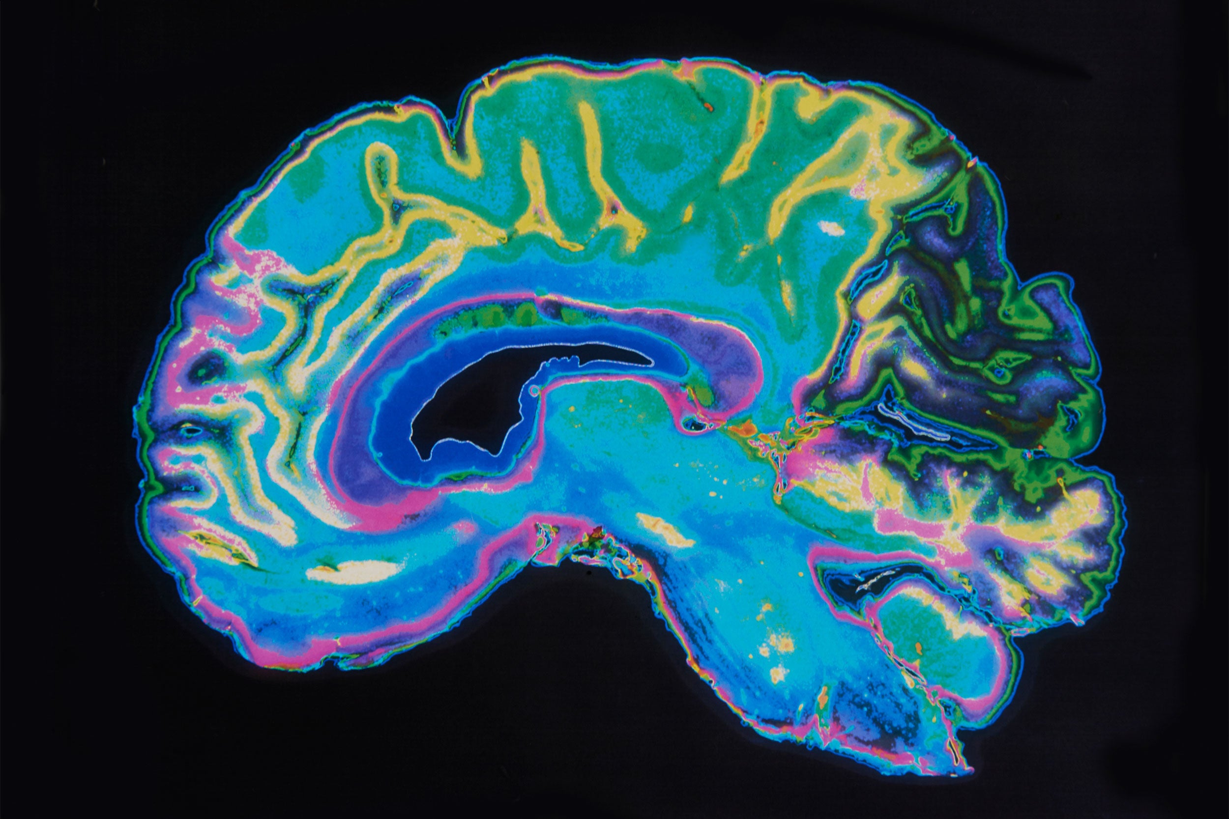 generic image of brain scan.
