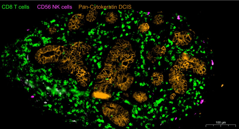 This picture shows the enrichment of immune cells in breast tissues.