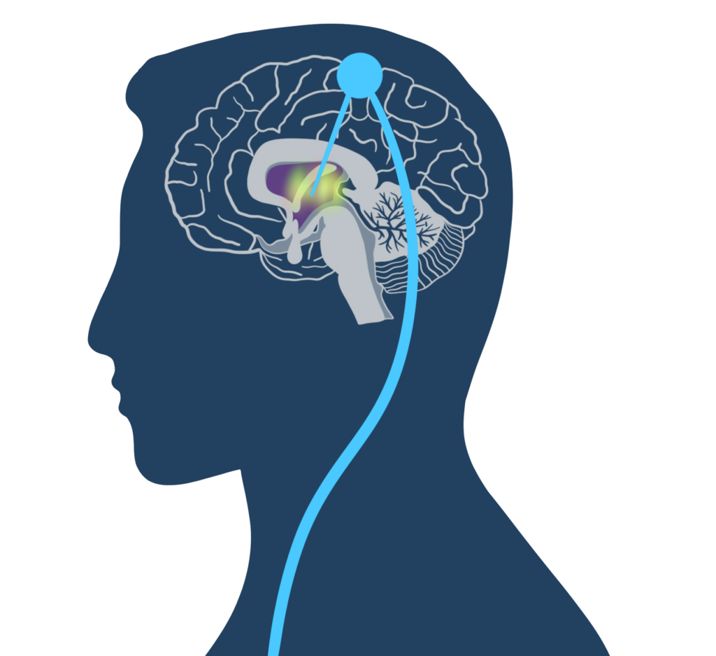 The electrodes stimulate the thalamus.
