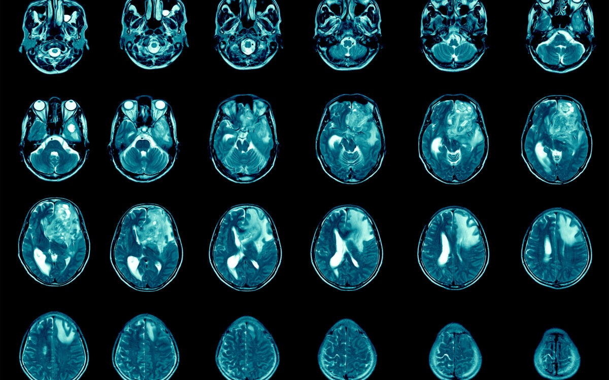 MRI showing glioblastoma.