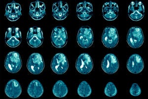 MRI showing glioblastoma.