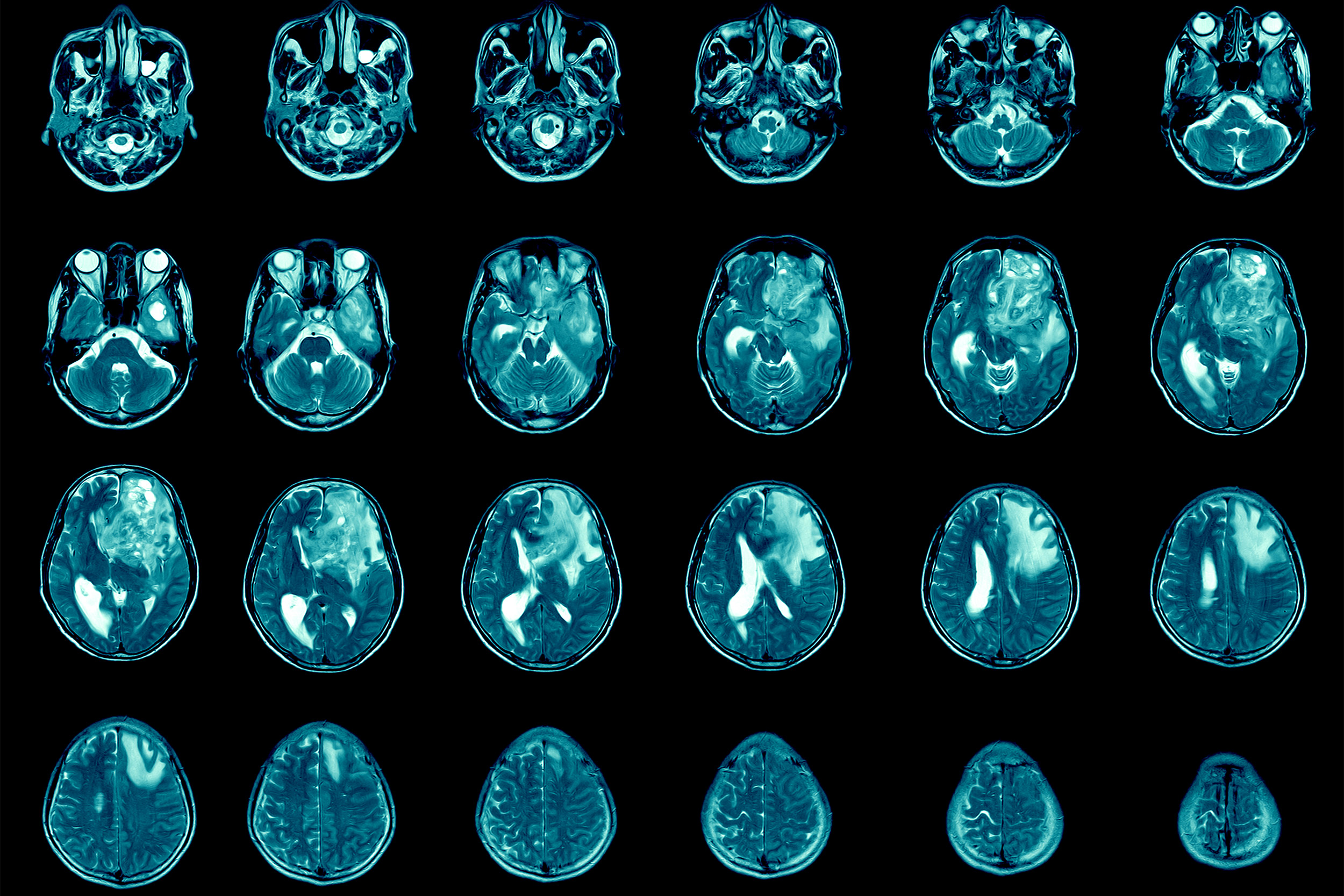Gallery Detail: Dramatic Inroads Against Aggressive Brain Cancer Harvard Gazette