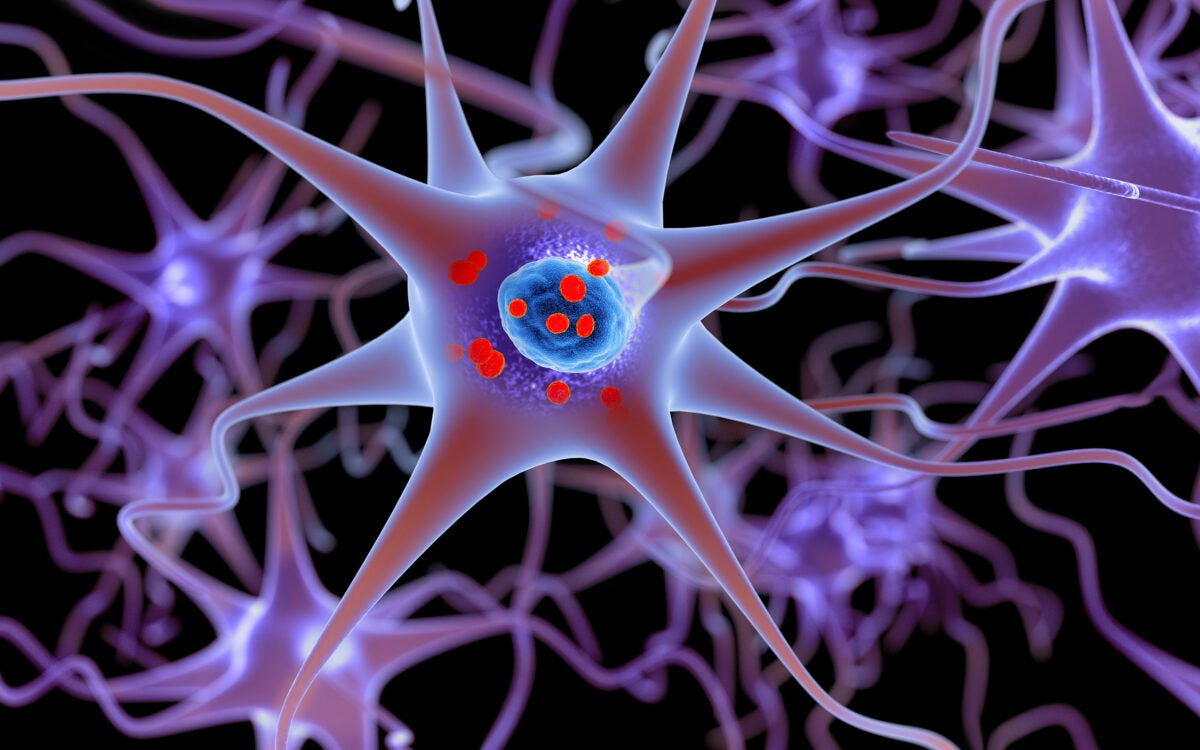 Illustration shows neurons containing deposits of alpha-synuclein (indicated with small red spheres) that have accumulated in the brain cells.