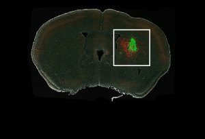 Researchers revealed which neurons in a mouse brain, shown in red, connect to a human glioma, shown in green.