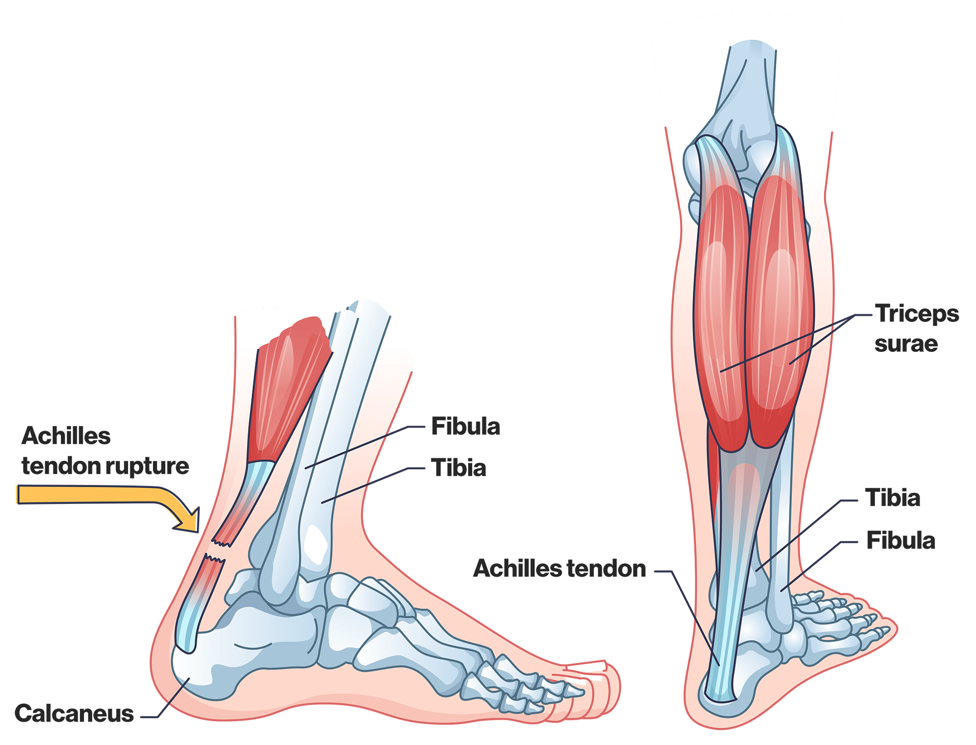 Diagram of location of achilles tendon.