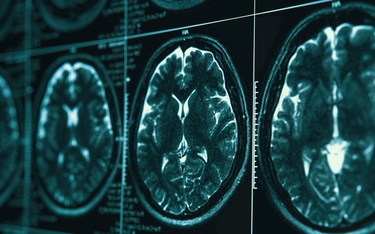 brain scnas