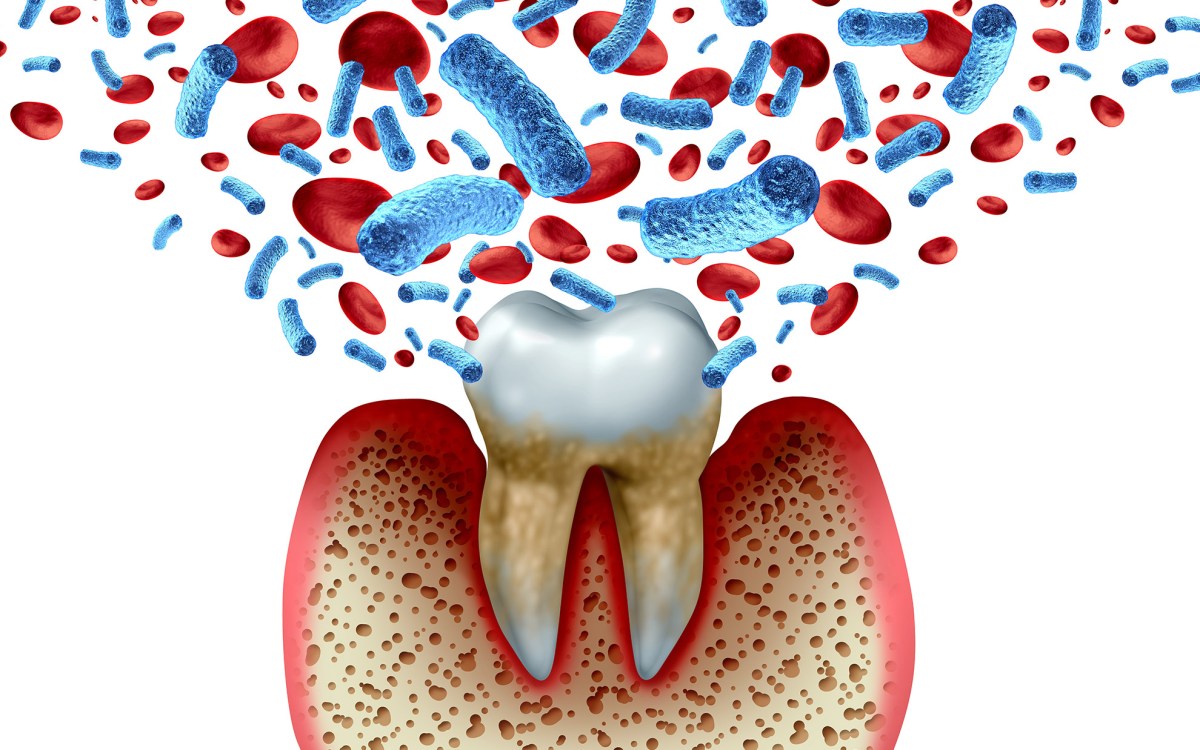 Illustration of tooth decay with inflammation and gum disease.